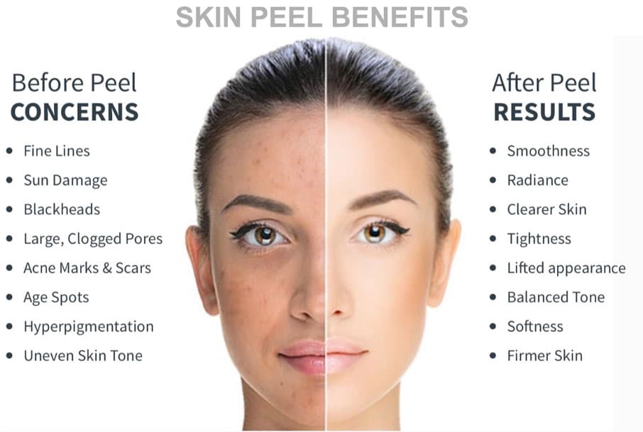 skin peel benefits
