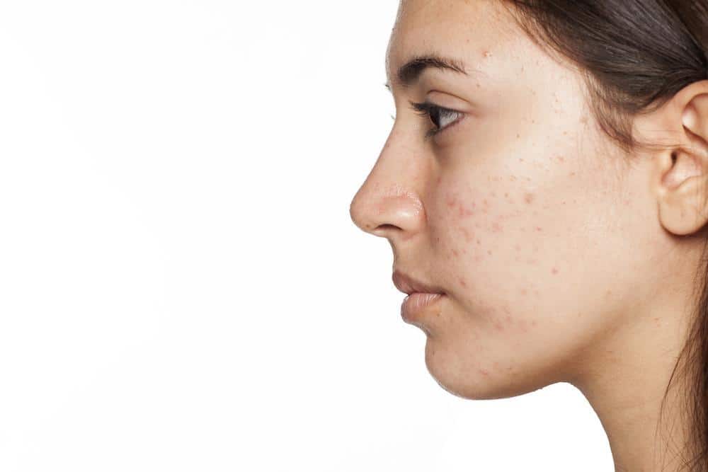 Adult Acne? Try Preston’s Solutions