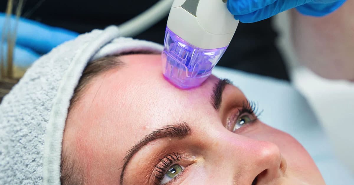 Soothing the Experience: Numbing Cream for Radiofrequency Microneedling